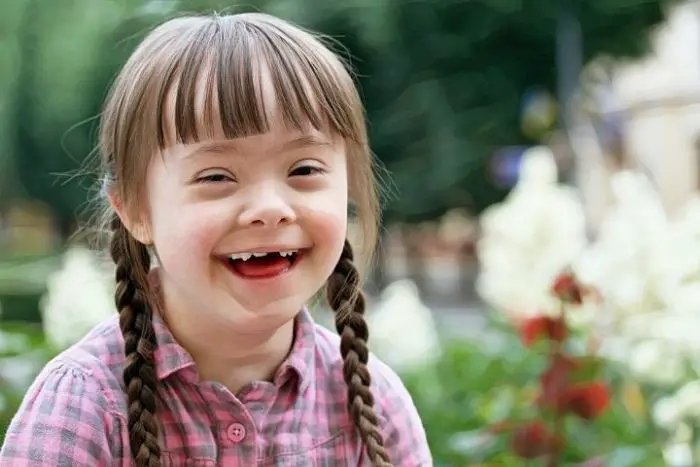 Lo que se debería saber sobre el síndrome de Down